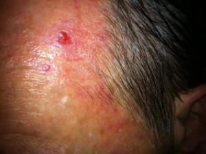 Oct. 26, 2011 - left frontal - open wound